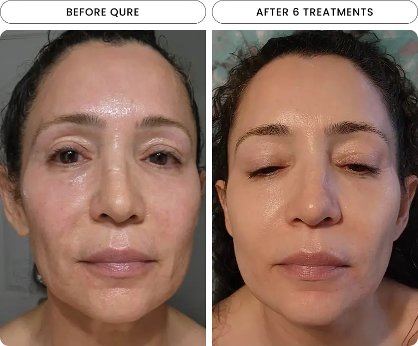 Micro-Infusion 6 Month (For Wrinkles + Dark Spots) (Pre-order) - Image 4