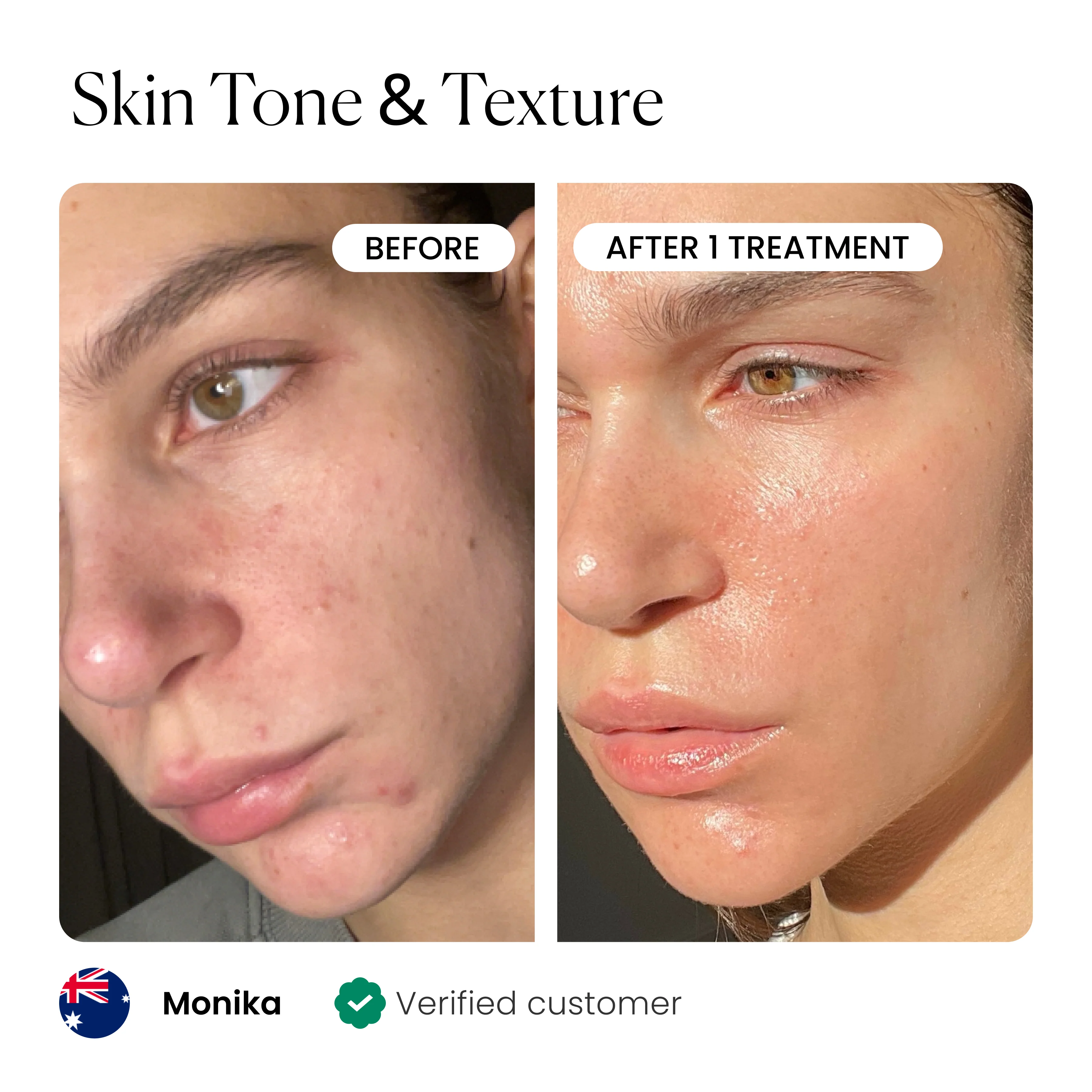Micro-Infusion 1 Month Bundle (For Wrinkles) - Image 3