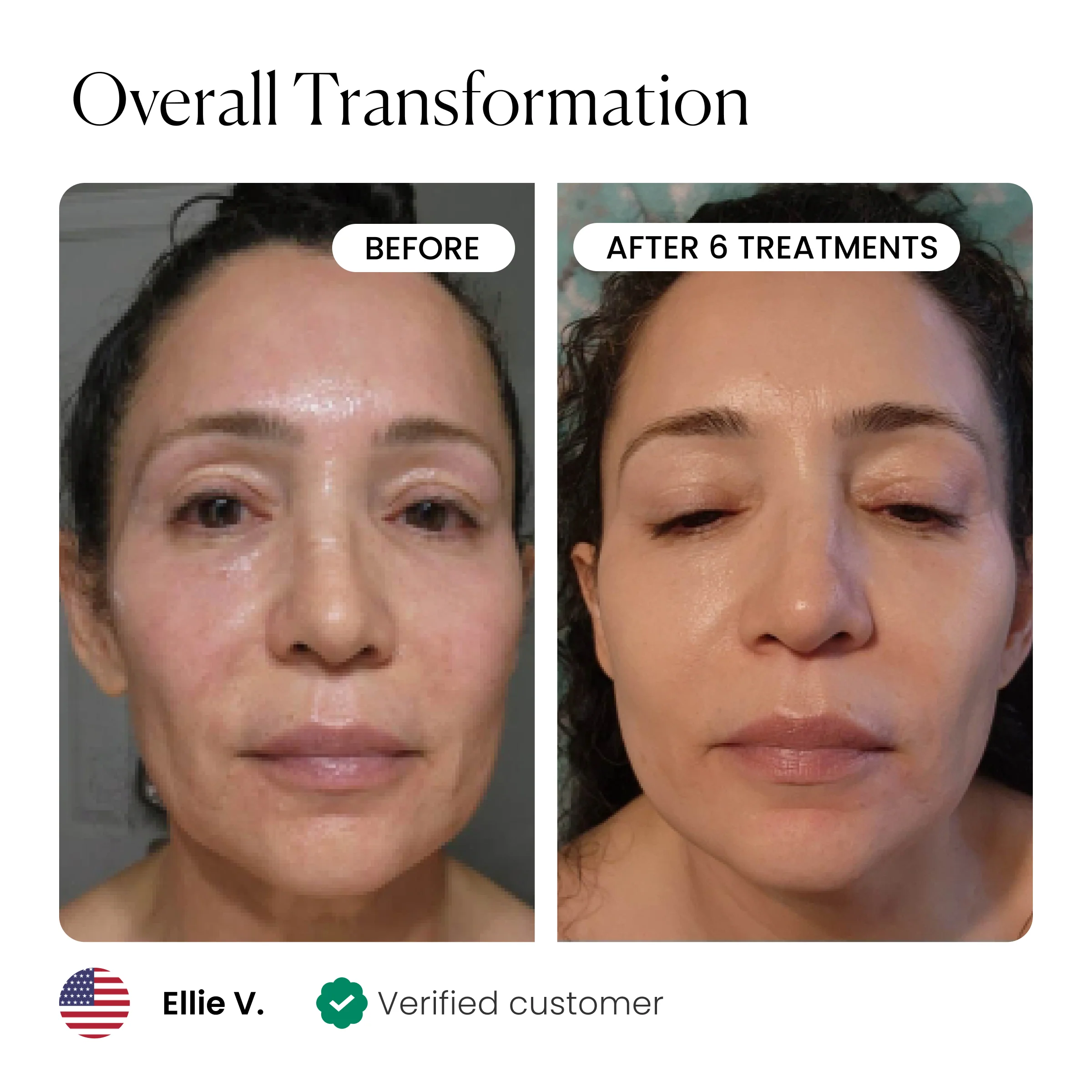 Micro-Infusion 1 Month Bundle (For Wrinkles) - Image 4
