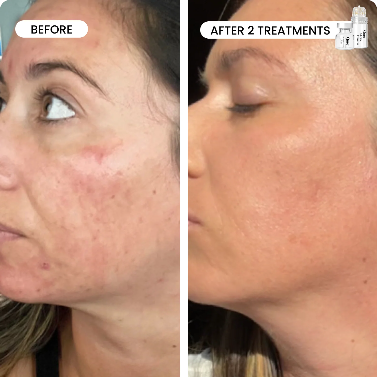 Micro-Infusion 2 Month Bundle (For Dark Spots) - Image 3