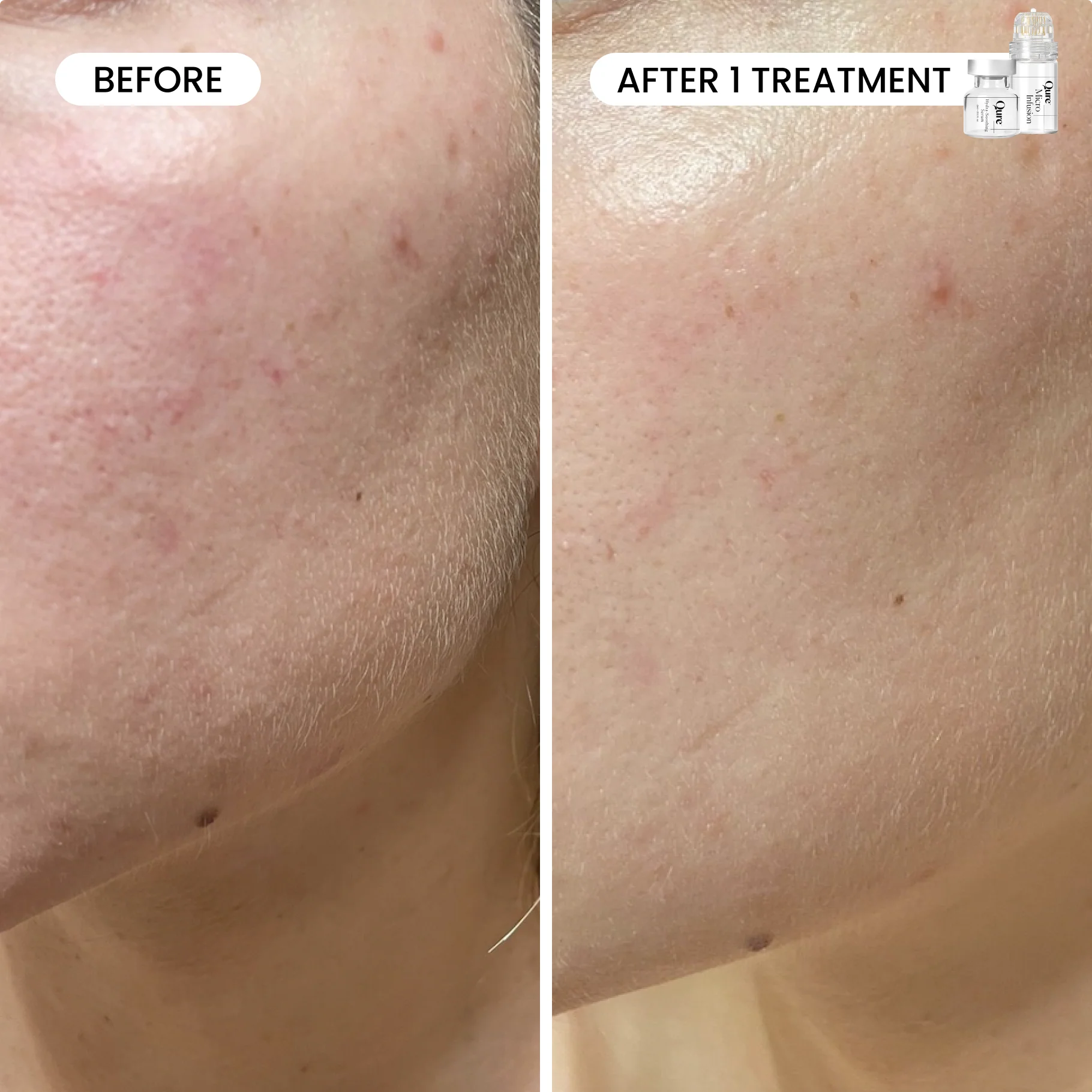 Micro-Infusion 2 Month Bundle (For Dark Spots) - Image 4