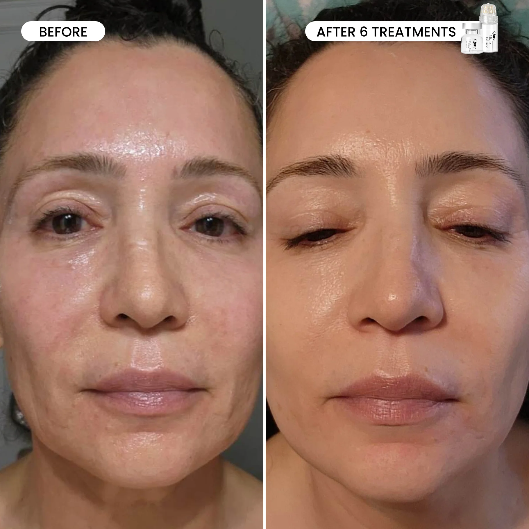 Micro-Infusion 3 Month Bundle (For Dark Spots) (Pre-order) - Image 4