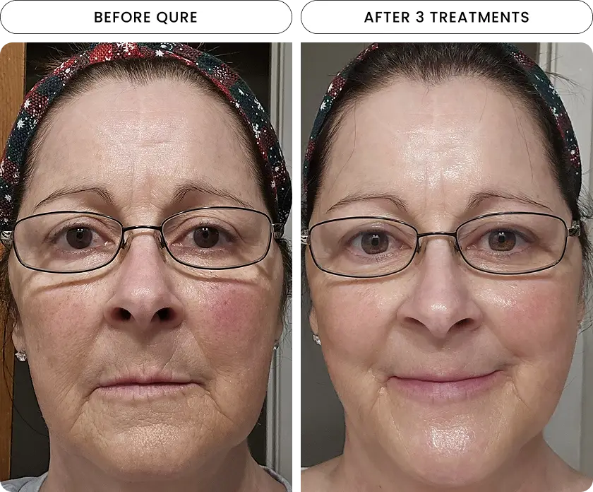 Micro-Infusion 6 Month Bundle (For Dark Spots) (Pre-order) - Image 2